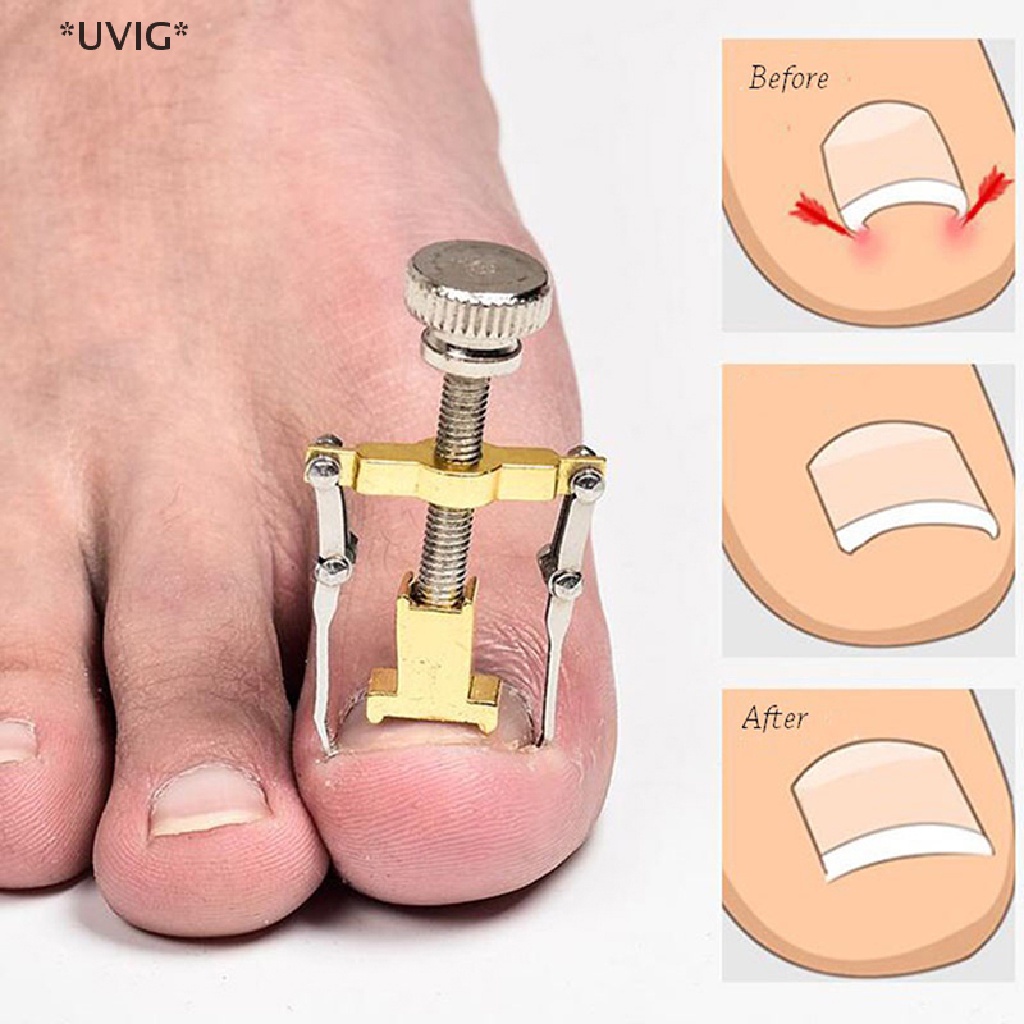 [[UVIG]] Ingrown toenail correction tool, foot care tool for pedicure, easy to use [Hot Sell]