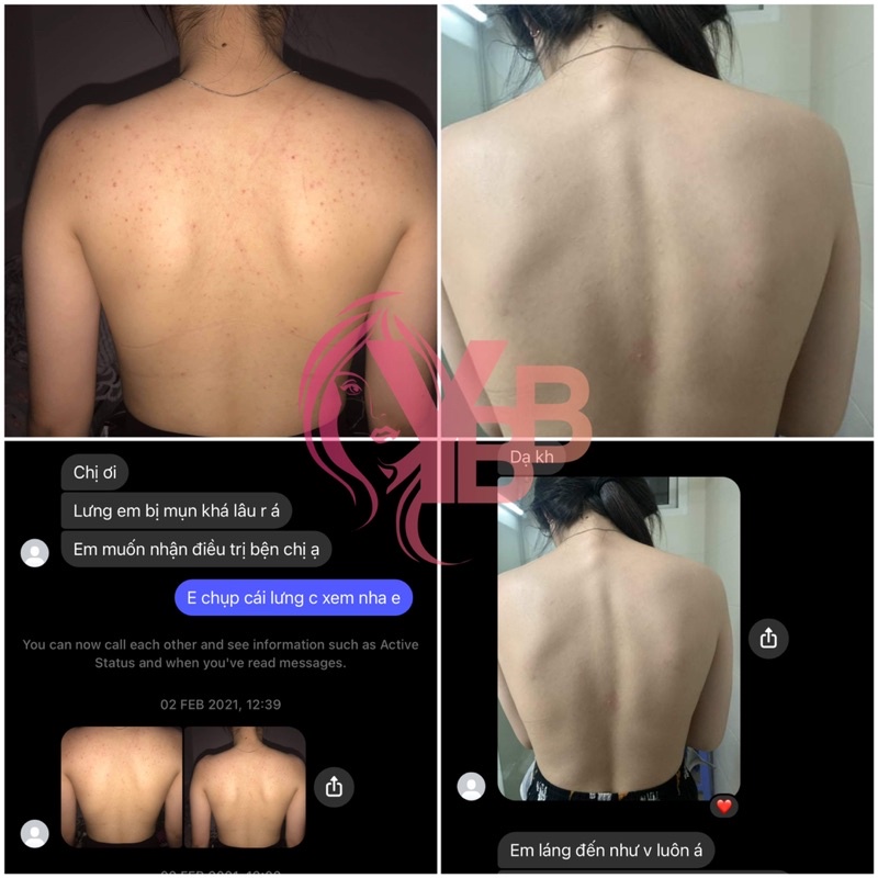 Nhất Nam Dược mụn lưng & mụn nang lông