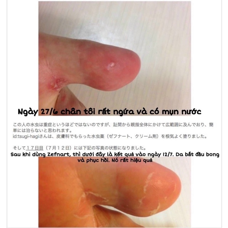 KEM BÔI DA NẤM ZEFNART 2% BỆNH VIỆN NHẬT