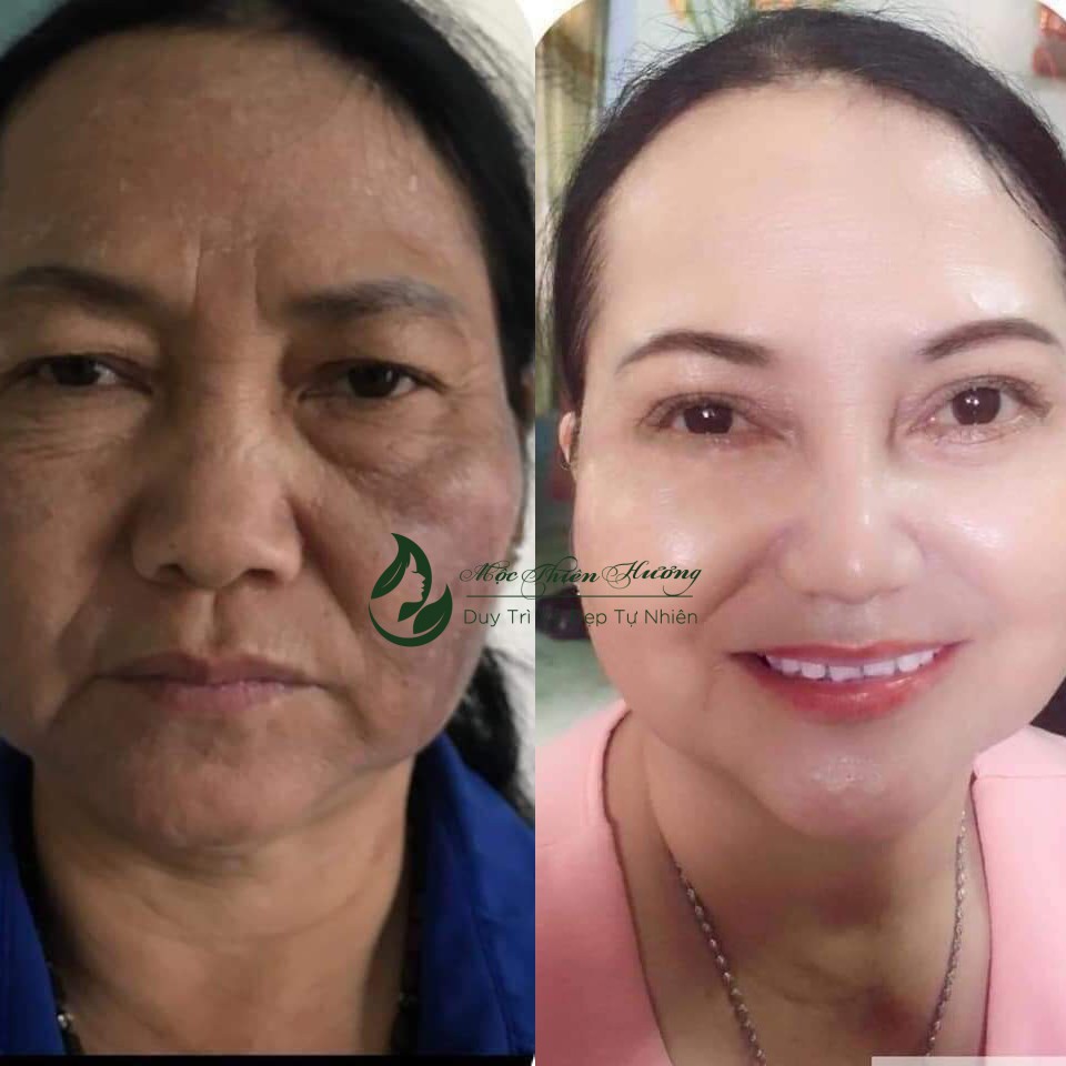 Combo Dành Cho Da Nám, Dưỡng Trắng Da Cấp Tốc Mộc Thiên Hương | BigBuy360 - bigbuy360.vn