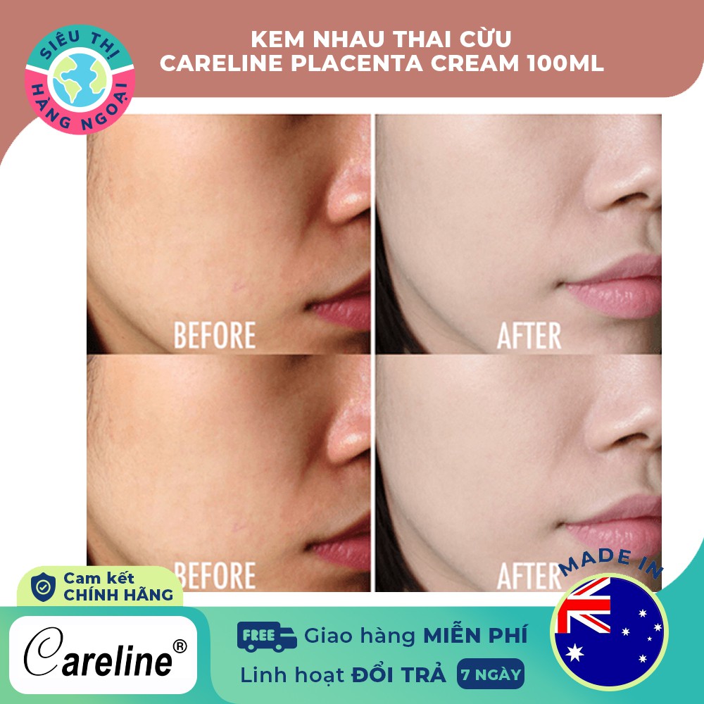 Kem Nhau Thai Cừu Careline Placenta Cream[dưỡng ẩm,phù hợp da khô &amp; nứt nẻ] Hàng Úc(được bán bởi Siêu Thị Hàng Ngoại)