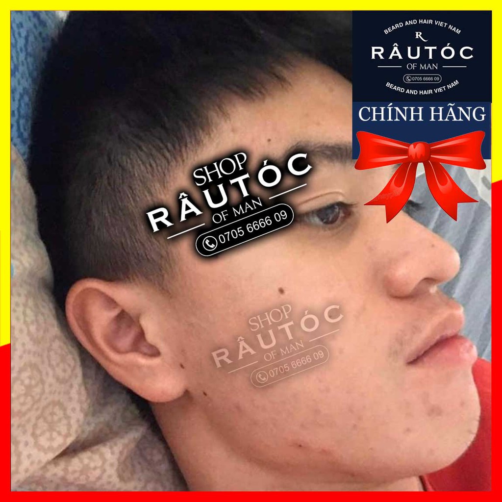 Thuốc mọc râu Minoxidil 5% hộp 6 lọ dạng lỏng