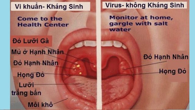 Amidan Ho Viêm Họng Hạt Cụ Làng Nghè