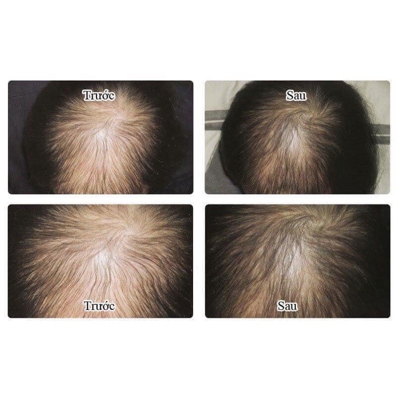 Minoxidil Bailleul 5% và 2% - Xịt mọc tóc Minoxidil nhập khẩu Pháp - Hộp 3 lọ 60ml - Date 2024, Mẫu mới nhất