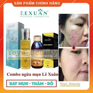 Combo ngừa mụn thảo dược đông y Lê Xuân