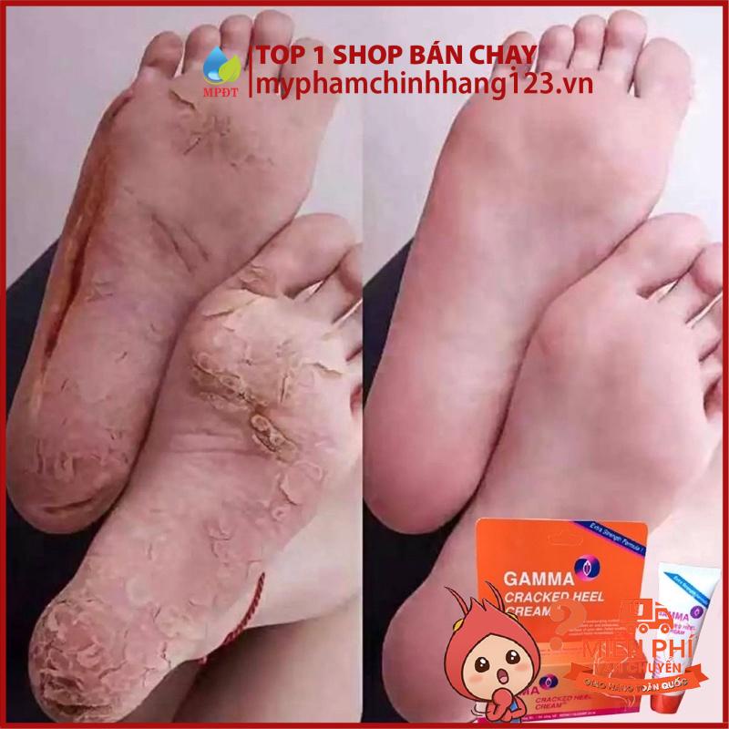 Kem giảm nứt gót chân, khô nứt da Gamma Cracked Heel