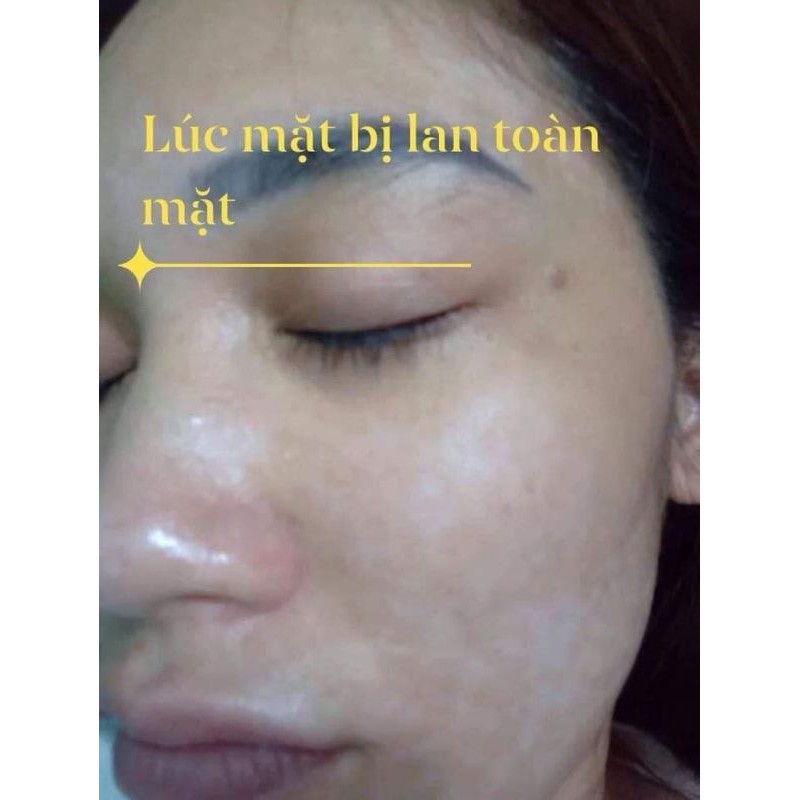 Đèn Philip UVB 311 Nm Chữa Bạch Biến - Vảy Nến - Viêm Da Cơ Địa (Hàng mới 100% chưa qua sử dụng)