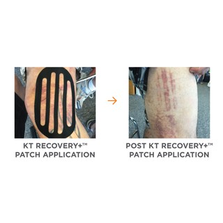 Miếng dán hỗ trợ hồi phục KT RECOVERY+®