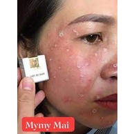 Chấm tàn nhang sẹo lõm đồi mồi nốt ruồi sẹo lồi Yody White Phương Anh