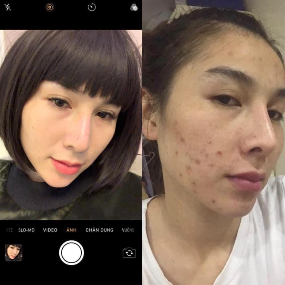 Combo chăm sóc da mụn , dưỡng ẩm và bảo vệ da H2T natural cosmetic❤️FREESHIP❤️ | BigBuy360 - bigbuy360.vn