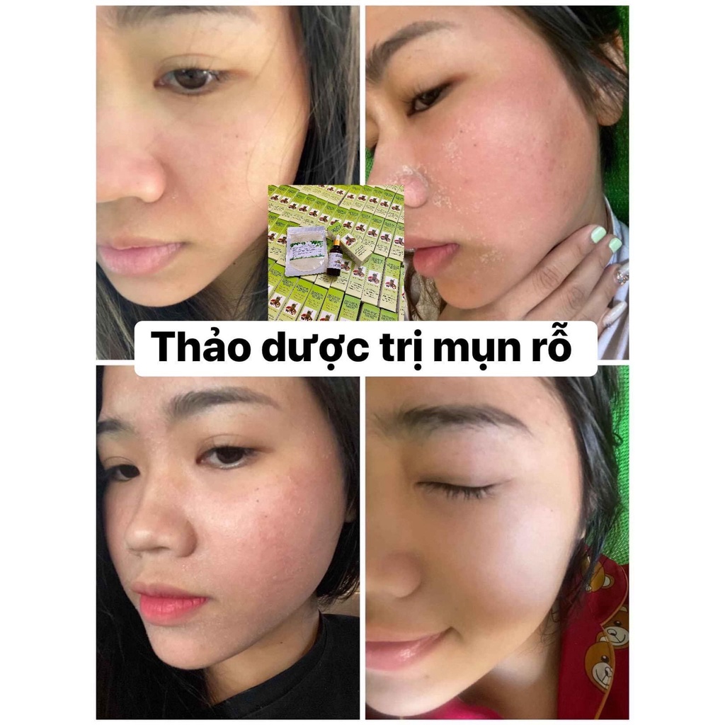 THẢO DƯỢC SẠCH MỤN MT (50ml) Tặng LỘT MỤN