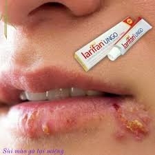 Loại bỏ mụn cóc sinh dục, sùi mào gà bằng kem bôi larifan ungo 1g.c( cam kết che sản phẩm khi giao).