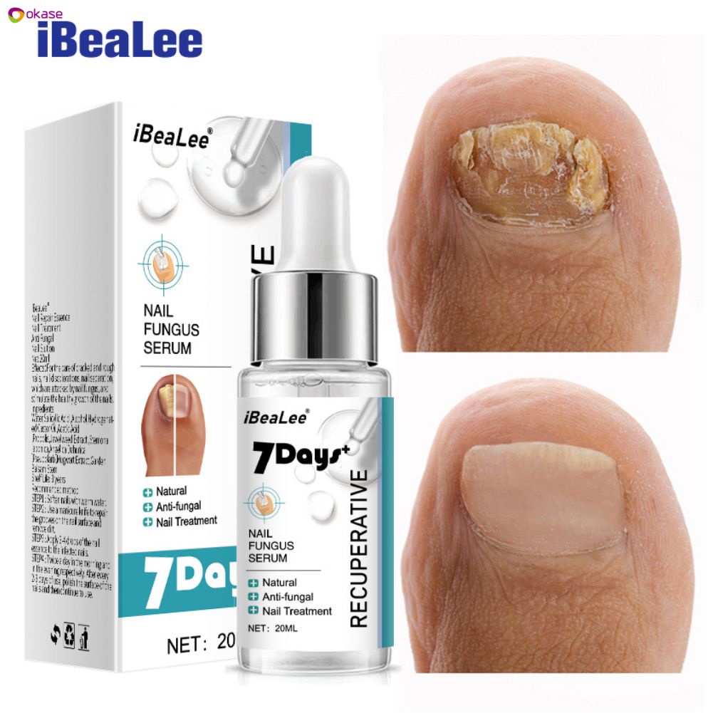Ibealee Kháng Khuẩn Đặc Biệt Chất Lỏng Cho Onychomycosis Loại Bỏ Móng Kem Làm Dày Mềm Mại Móng Onychomycosis Okase