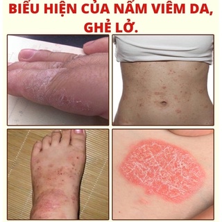 kem bôi hết Á.sưng,t.ổ đia,zoo.nan thân k.inh,nấ.m da Đau,chân tay Hoàng minh đường