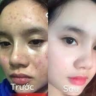 ⭐ CHUYÊN SỈ ⭐ 𝐇𝐔̃ 𝐊𝐄𝐌 𝐓𝐑𝐈̣ 𝐍𝐀́𝐌 𝐓𝐀̀𝐍 𝐍𝐇𝐀𝐍𝐆 , 𝐓𝐑𝐈̣ 𝐌𝐔̣𝐍 𝐓𝐇𝐀̂𝐌 𝐓𝐑𝐎̀𝐍 𝐁𝐀𝐍 Đ𝐄̂𝐌 𝐂𝐋𝐎𝐁𝐄𝐓𝐀𝐌𝐈𝐋 𝐆 𝐓𝐇𝐀́𝐈 𝐋𝐀𝐍