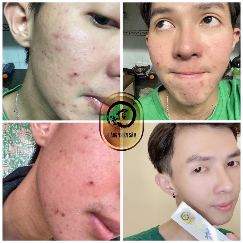 combo Hoàng Thiên Sâm VIP ⚡️Freeship ⚡️trả lại làn da trắng mịn đều màu với bản VIP | BigBuy360 - bigbuy360.vn