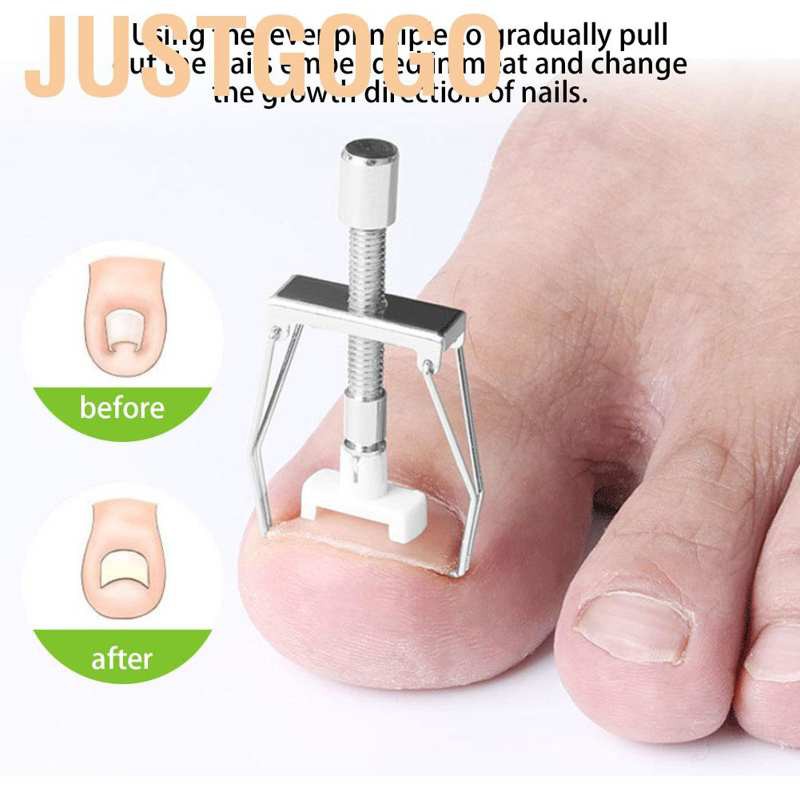 💥Ingown Toenail Fixer Điều chỉnh ngón chân Móng chân Viêm móng chân Corrector Bộ dụng cụ trị liệu chân