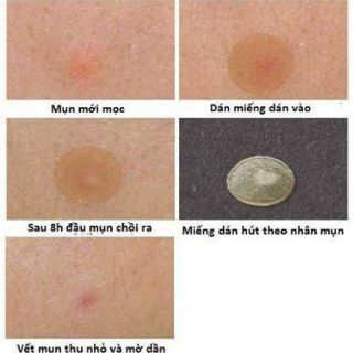 Miếng dán mụn Korea ☺️