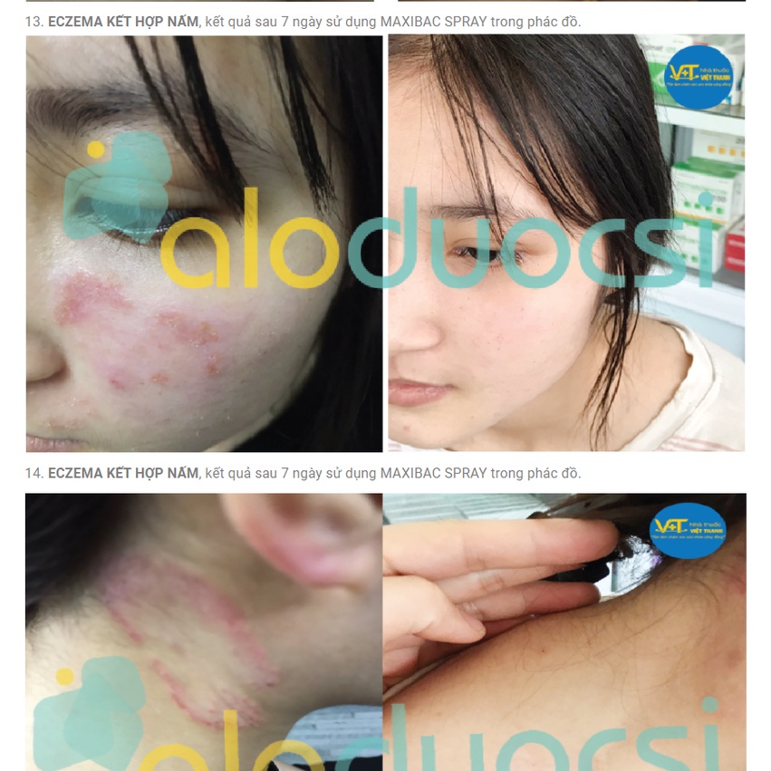 Xịt kháng khuẩn Maxibac nhanh lành da do bỏng, vết loét, ezecma, zona, thủy đậu [nano bạc]