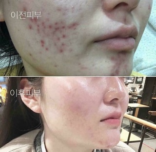 Redpeel thay da sinh học