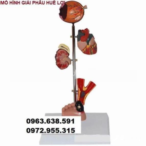 MÔ HÌNH TỔN THƯƠNG 5 CƠ QUAN ĐÍCH CỦA BỆNH TIỂU ĐƯỜNG