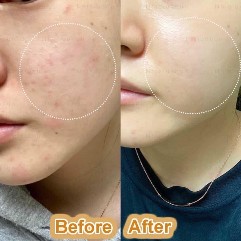 Kem kiểm soát dầu và điều tiết nhờn Floslek Anti Acne Mattifying Cream 50ml