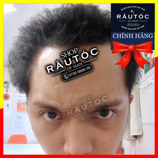 Mọc râu tóc Minoxidil 5% Foam Rogaine