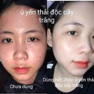 Mặt nạ ủ yến thải độc Magic Skin