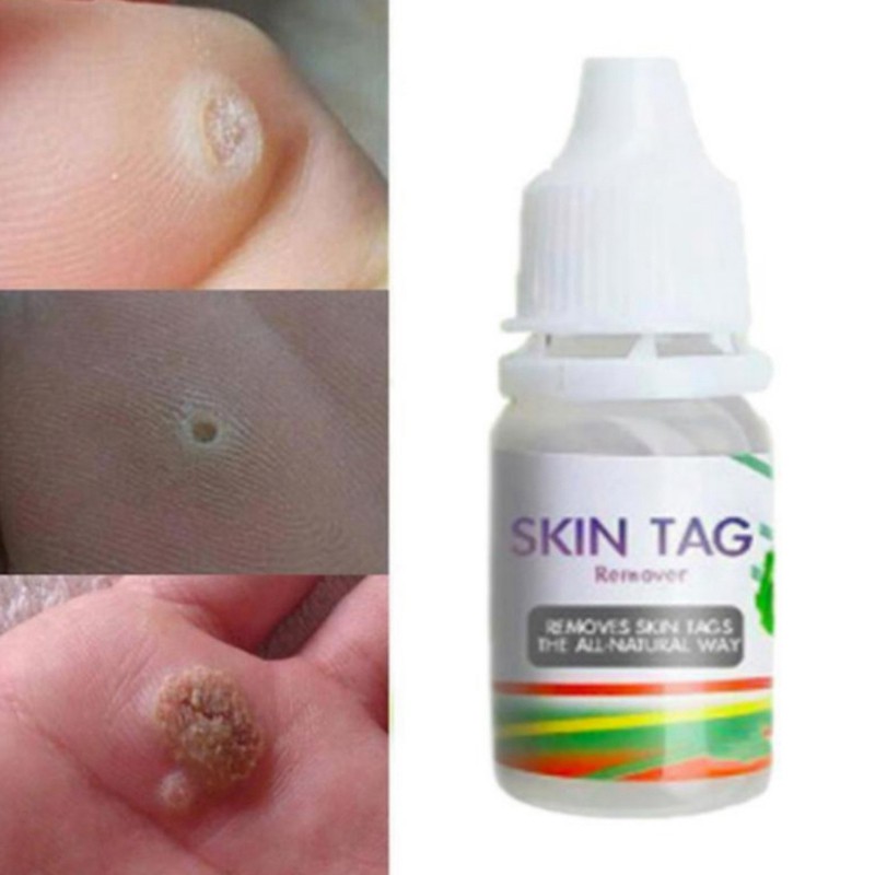 12 Hours Skin Tag Mole & Genital Wart Remover Foot Corn Removal 10Ml