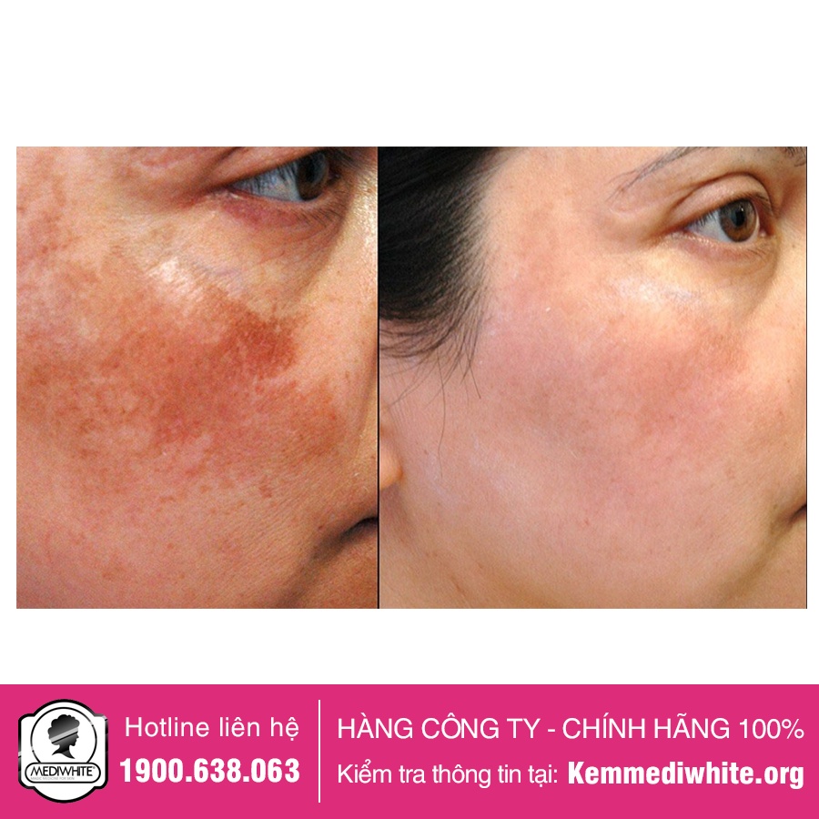 Kem Nám Medi White Chính Hãng - Medi Melasma - Kem Mờ Thâm Nám Tàn Nhang Trắng Da Medi White - Hàng Công Ty