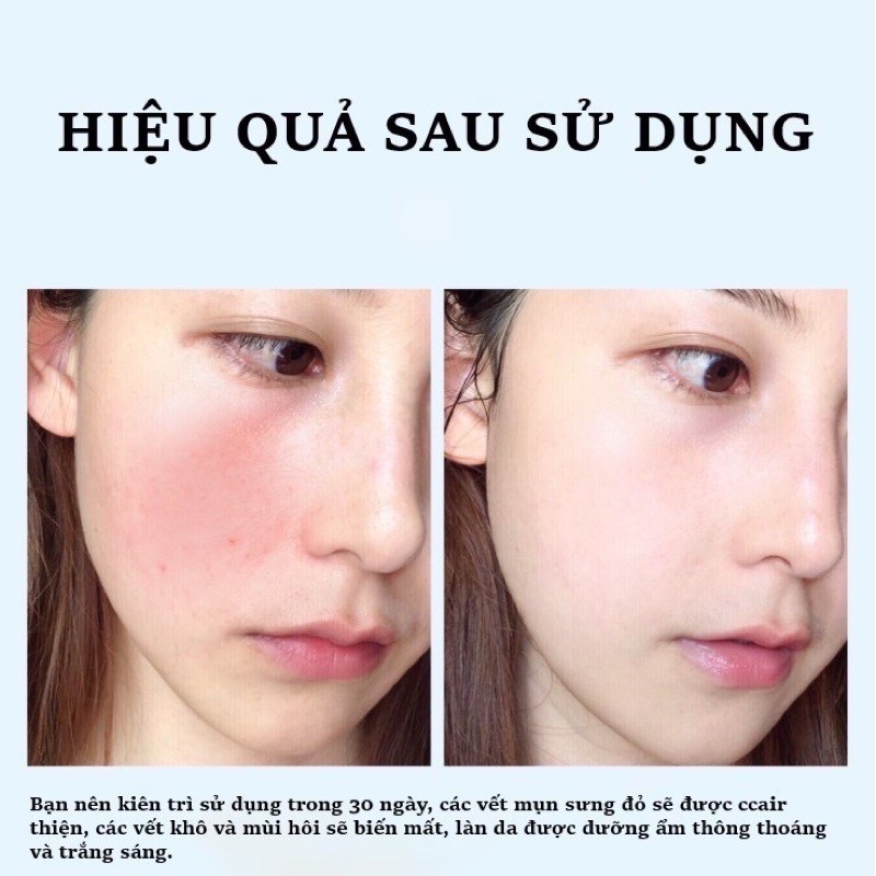 MẶT NẠ LÀNH MỤN RAU MÁ HIISEES DƯỠNG TRẮNG SE LỖ CHÂN LÔNG