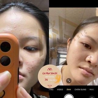 COMBO 2 CAO MỤN SÂM ĐỎ MEEA