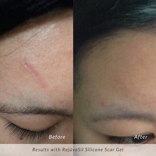 Miếng dán Scar fx 2.5x10cm chuẩn mỹ