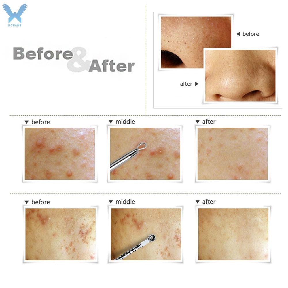 Dụng Cụ Nặn Mụn Hai Đầu Bằng Thép Không Gỉ An Toàn | BigBuy360 - bigbuy360.vn