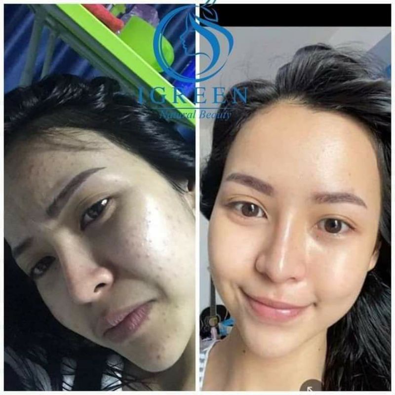 Serum SẠCH MỤN DIẾP CÁ IRGEEN_ GIẢM MỤN, GIẢM THÂM , SE KHÍT LỖ CHÂN LÔNG, SÁNG DA | BigBuy360 - bigbuy360.vn