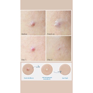 Miếng dán mụn Balea của Đức (36 miếng)