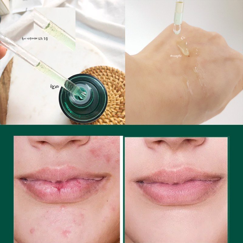 Serum Some By Mi Giảm Mụn Thần Kỳ 30 Ngày AHA-BHA-PHA 30 Days Miracle Serum 50ml - Khongcoson