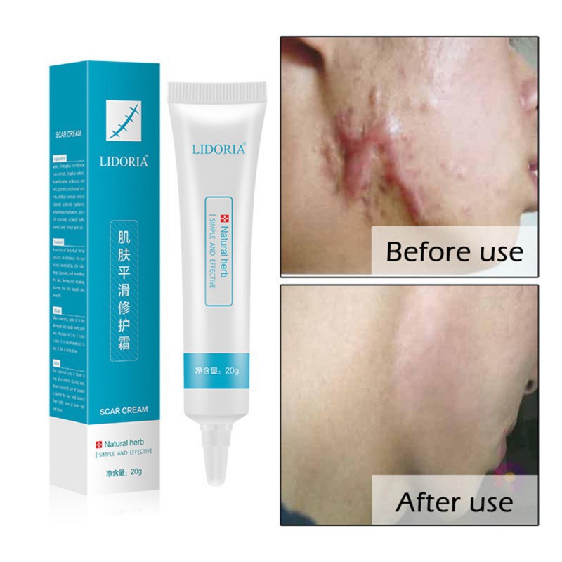 [Hàng mới về] Kem chăm sóc da mặt LIDUOLIYA 20g hydrat hóa loại bỏ sẹo mụn cho da mịn màng | BigBuy360 - bigbuy360.vn