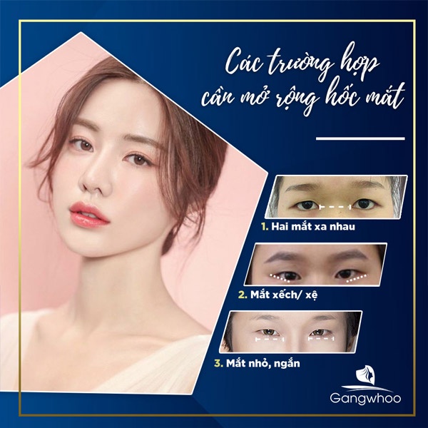 Dịch vụ Tạo hình góc mắt tại Gangwhoo