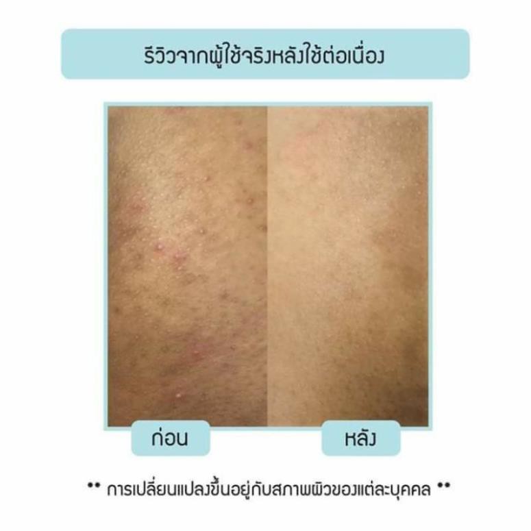 2 TUÝP NAKIZ LIVELY BUTT 〡 Kem thoa thâm Mông, Bẹn, Nách, Lưng, Nhũ hoa, Đầu gối, Cùi chỏ.... Thái Lan | BigBuy360 - bigbuy360.vn