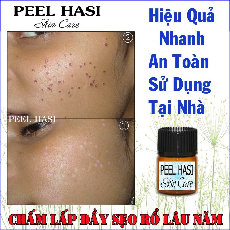 Chấm Đầy SẸO RỖ Lâu Năm. Quét Nám Tàn Nhang Peel HA SI