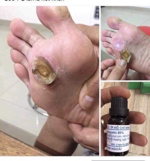 Thuốc đặc trị mụn cơm mụn cóc mắt cá chân