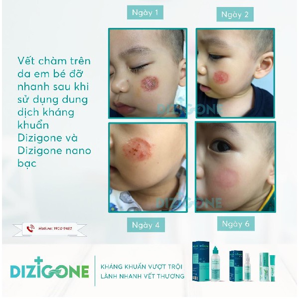 [Combo 3] Dizigone 300ml + Dizigone Spray 100ml + Kem Dizigone Nano Bạc: Kháng Khuẩn Da, Lành Vết Thương, Ngăn Ngừa Sẹo