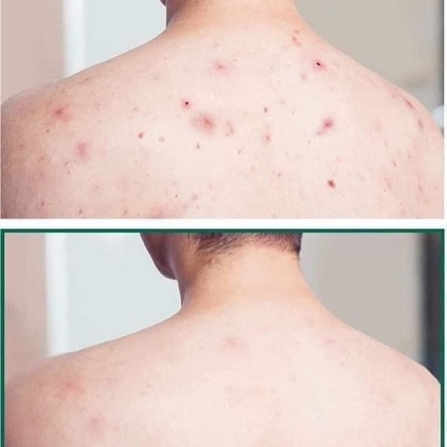 Sữa tắm Trị mụn lưng Somebymi | BigBuy360 - bigbuy360.vn