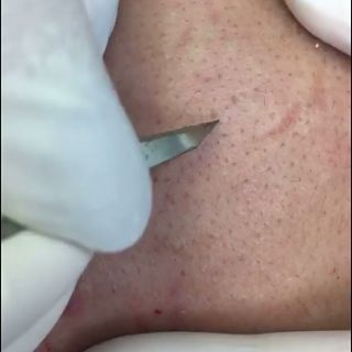 Dụng cụ nặn mụn Dao nặn mụn y tế
