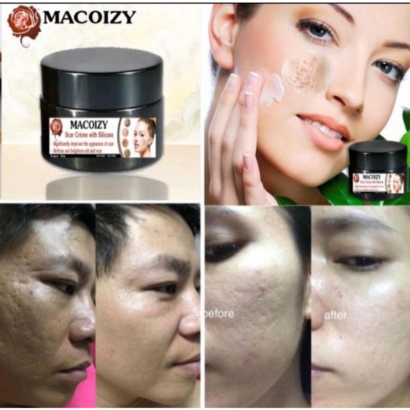 Kem Xóa Sẹo Rỗ MACOIZY Dưỡng Trắng Hết Thâm