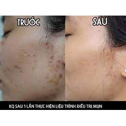 [HÀNG CHÍNH HÃNG] Tảo nano căng bóng (vi kim thảo dược mẫu mới)