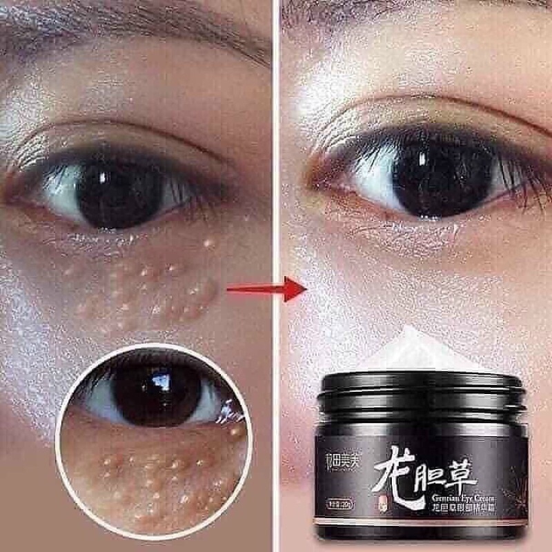 Kem bôi mụn thịt