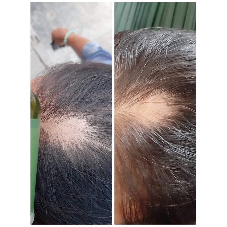 [ Tặng Cột Tóc + Date Mới ] Tinh Dầu Bưởi Vy Jully Giúp Gẫy Rụng Và Mọc Tóc Con 100ml | BigBuy360 - bigbuy360.vn