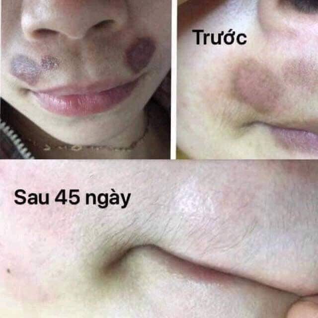 [CHÍNH HÃNG] - Kem mờ sẹo Scar Esthetique 10g - MỸ